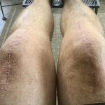Learning to Walk Again